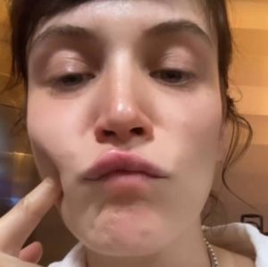 Bianca Bin mostra lábios inchados após picada: - <i>Coçando e queimando</i>