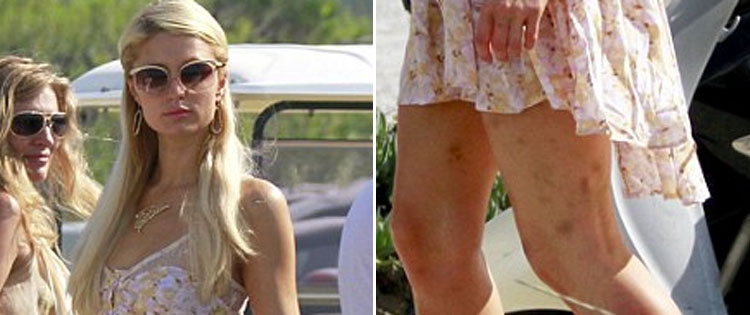 Paris Hilton exibe machucados na perna