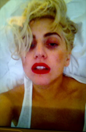 Lady Gaga posta foto com olho roxo após acidente em show