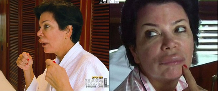 Mãe de Kim Kardashian tem reação alérgica e fica com lábio inchado