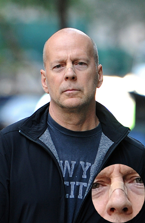 Bruce Willis é flagrado com curativo no nariz