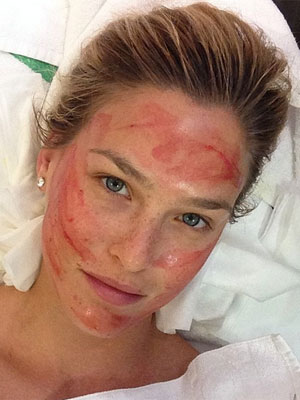 Bar Rafaeli faz um tratamento de beleza com próprio sangue