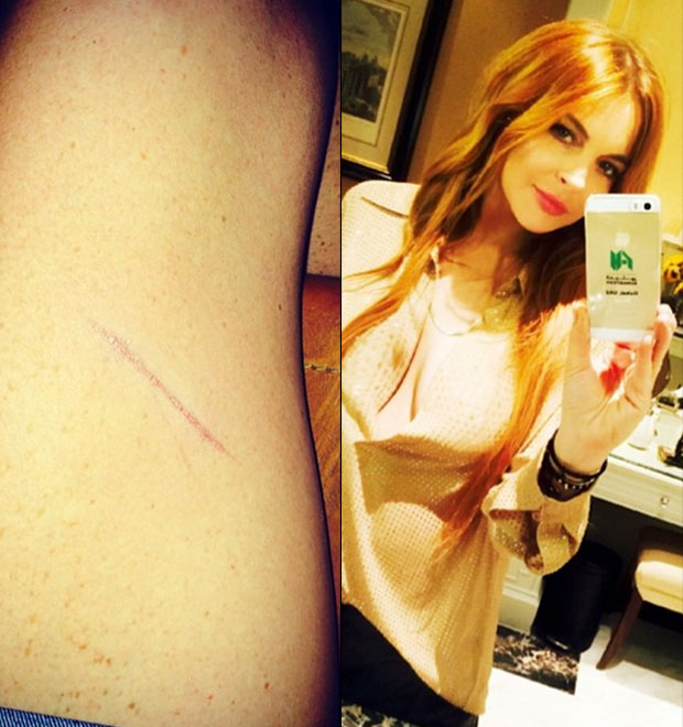 Lindsay Lohan explica arranhão na perna: <i>Passeio de bicicleta que deu errado</i>
