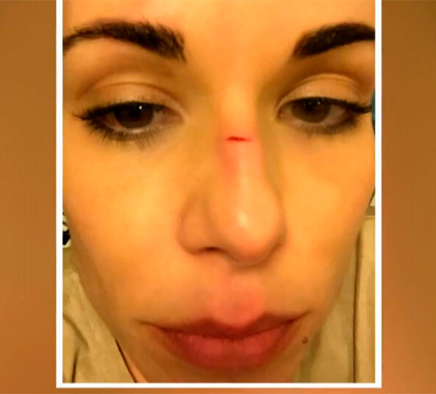 Ana Furtado fala sobre acidente doméstico: - <i>Fissurei o nariz e levei três pontos</i>