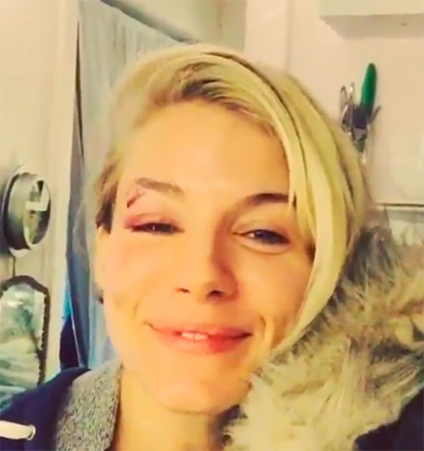 Sienna Miller aparece com o olho roxo após acidente na Broadway