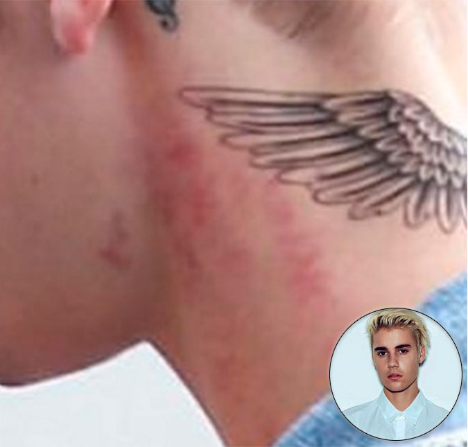 Justin Bieber explica marcas vermelhas no pescoço