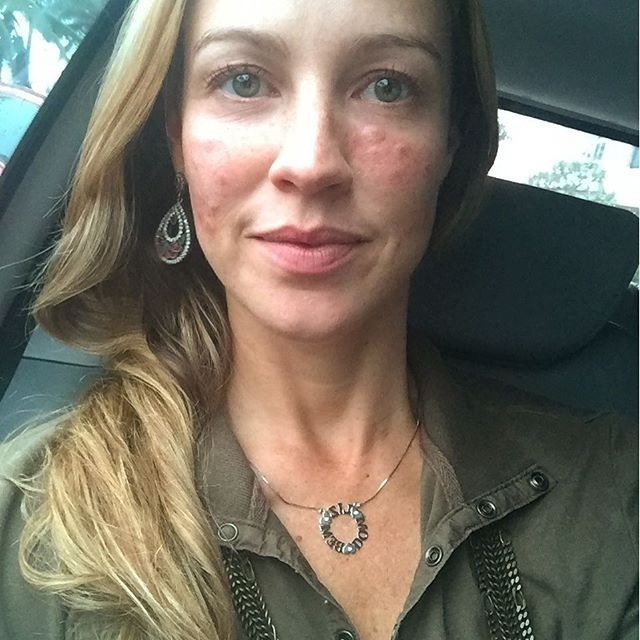 Luana Piovani mostra rosto inchado após tratamento de pele