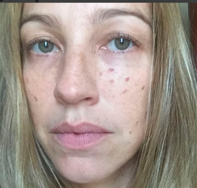 Luana Piovani mostra cicatrizes na pele e desabafa sobre atentado contra Ana Hickmann