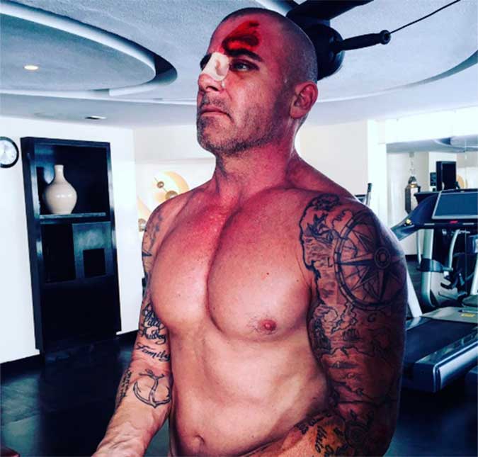 Depois de quebrar o nariz no <I>set</I>, Dominic Purcell, de <I>Prison Break</i>, prova que não se abateu!