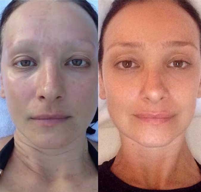 Sabrina Parlatore comemora um ano sem quimioterapia e posta foto com antes e depois