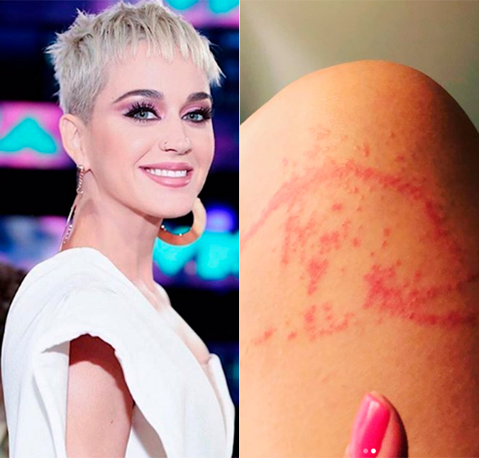 Katy Perry preocupa fãs ao exibir queimadura de água-viva
