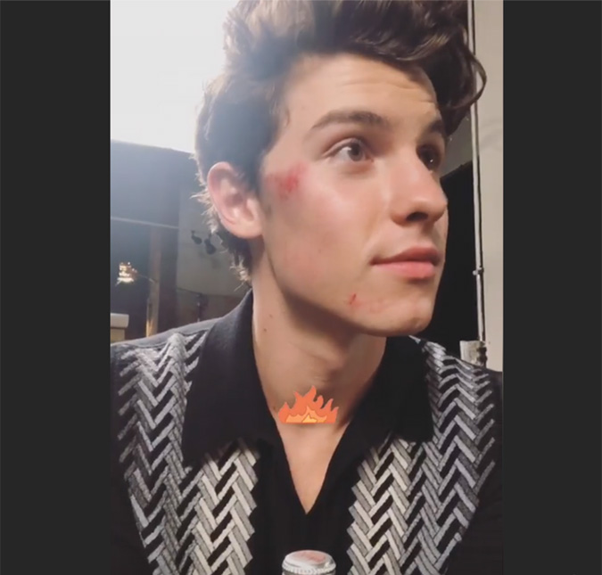 Após acidente, Shawn Mendes surge com o rosto todo machucado e assusta fãs