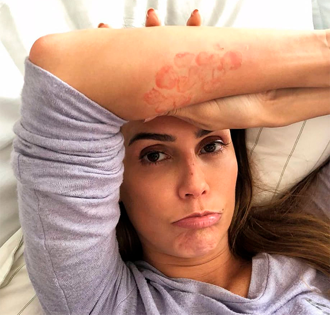 Deborah Secco explica o motivo das manchas vermelhas na pele