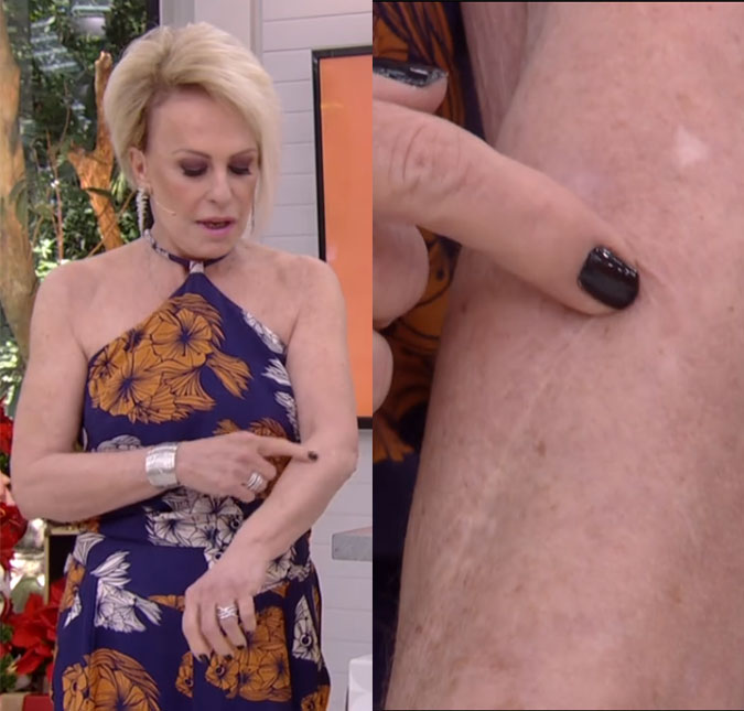Ana Maria Braga relembra câncer de pele e mostra cicatriz: <i>- Foi sério</i>