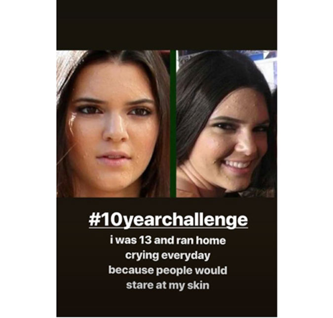 Kendall Jenner posta foto para relembrar problema com acne na adolescência: <i>Corria para casa chorando</i>