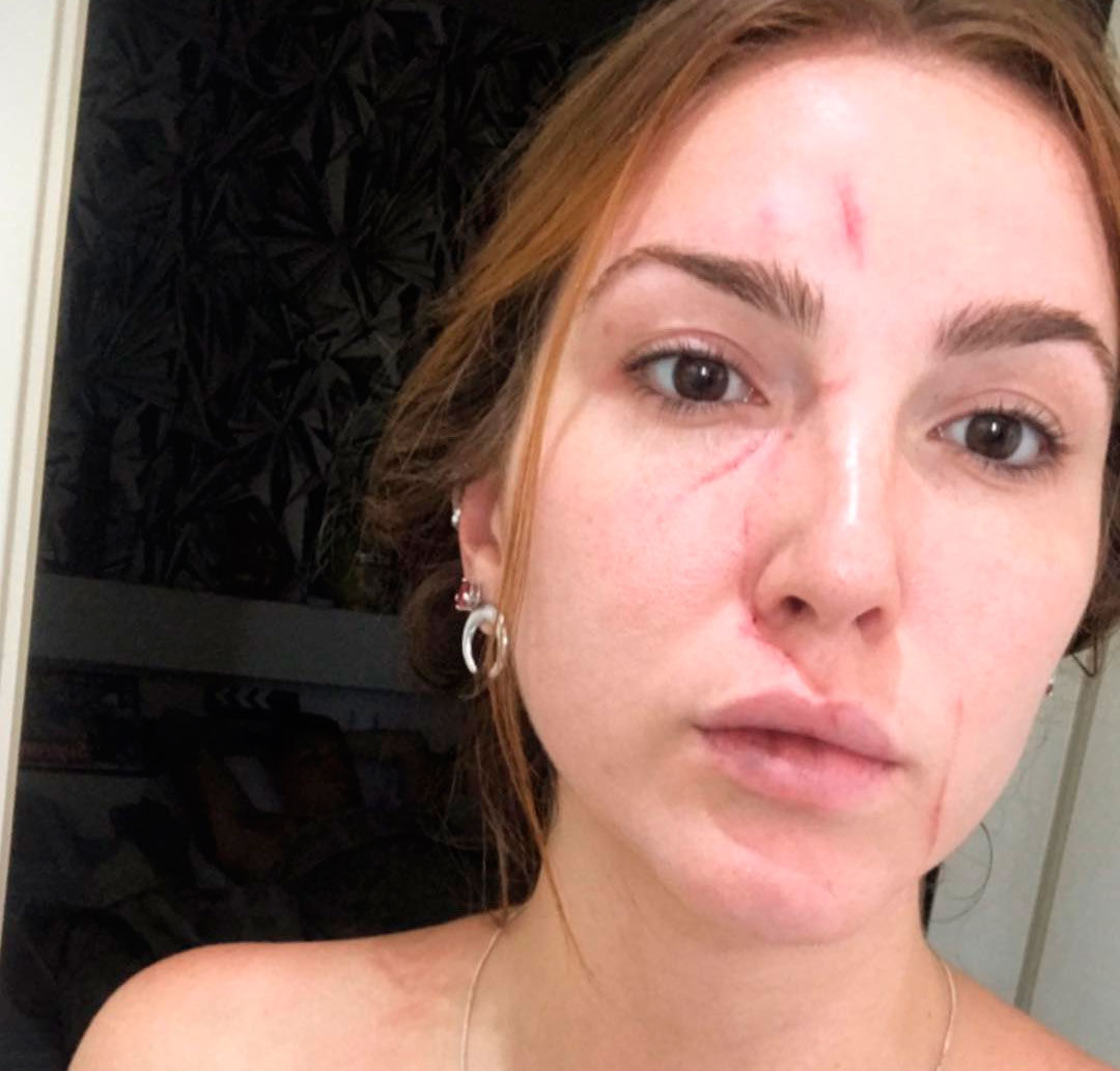 Ex-participante de <I>De Férias Com O Ex Brasil 3</I> é agredida em casa noturna: <I>Impotência</I>