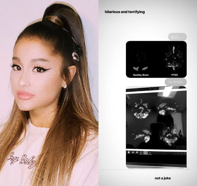 Após mostrar raio-x preocupante de seu cérebro, Ariana Grande tranquiliza fãs: <i>Não quis assustar ninguém</i>