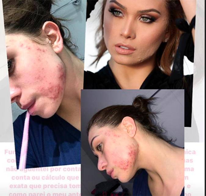 Flavia Pavanelli relembra crise de acne: <I>Tão dolorido que não conseguia encostar</i>