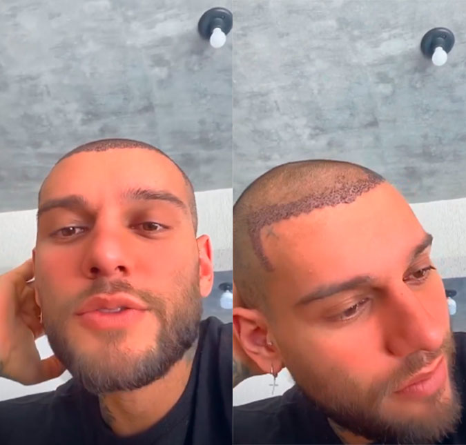 Após realizar transplante capilar, Lucas Lucco dá detalhes: <i>- Formando casquinha já</i>; assista ao vídeo!