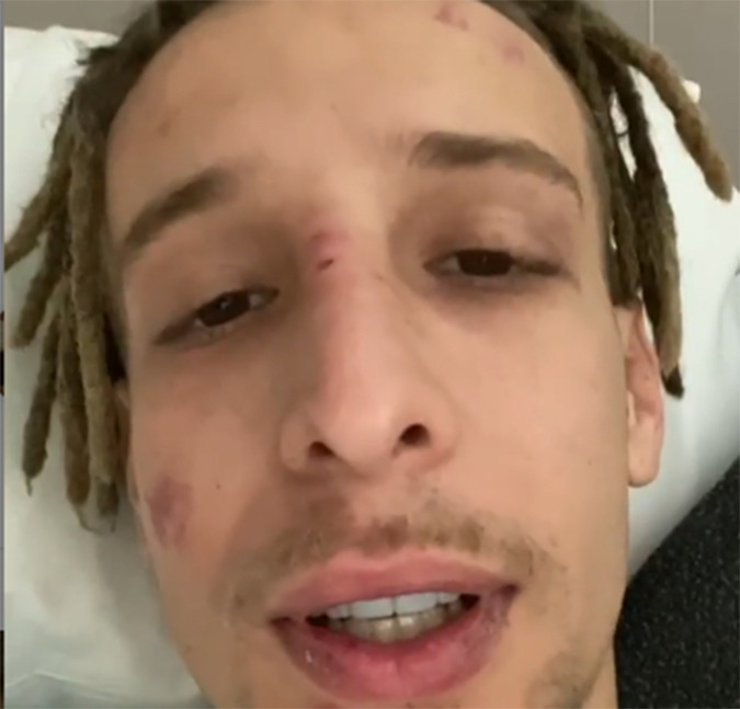 Após sofrer convulsão em <i>live</i>, Pedro Qualy, do <i>Haikass</i>, aparece com hematomas e afirma que fará cirurgia no ombro