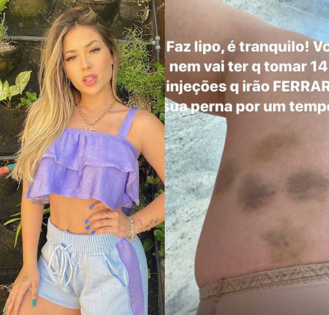 Após <i>lipo lad</i>, Virgínia Fonseca impressiona ao mostrar hematomas na perna