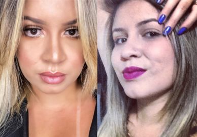 Marília Mendonça nega cirurgia plástica e diz ter feito apenas preenchimento labial. Compare!