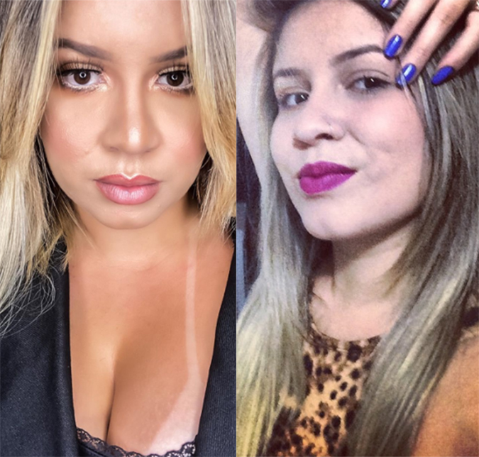 Marília Mendonça nega cirurgia plástica e diz ter feito apenas preenchimento labial. Compare!