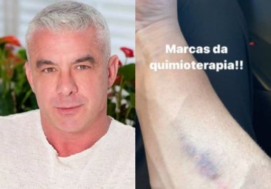 Marido de Ana Hickmann mostra hematomas no braço em meio a tratamento contra câncer: <i>Marcas da quimioterapia</i>