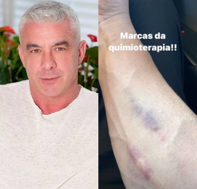Marido de Ana Hickmann mostra hematomas no braço em meio a tratamento contra câncer: <i>Marcas da quimioterapia</i>