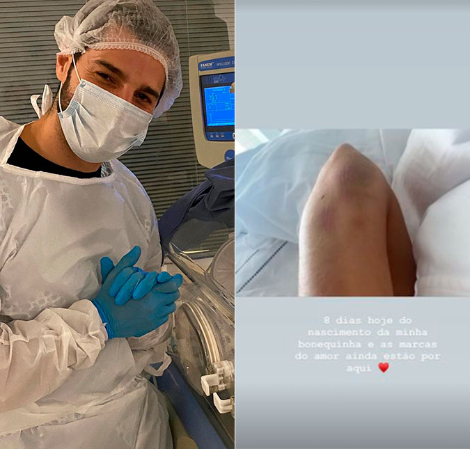Romana Novais exibe hematomas após parto de risco e Alok reencontra os filhos: <i>Caindo a ficha</i>