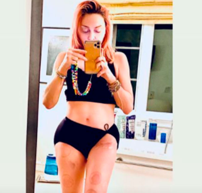 Madonna divulga foto mostrando boa forma e cicatriz de cirurgia na perna, veja!