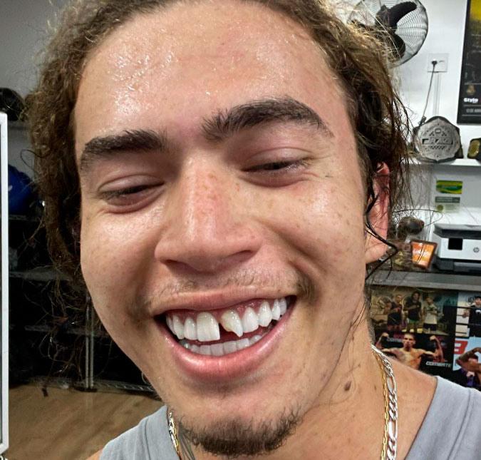 Whindersson Nunes quebra dente em treino de luta e faz piada com seguidores