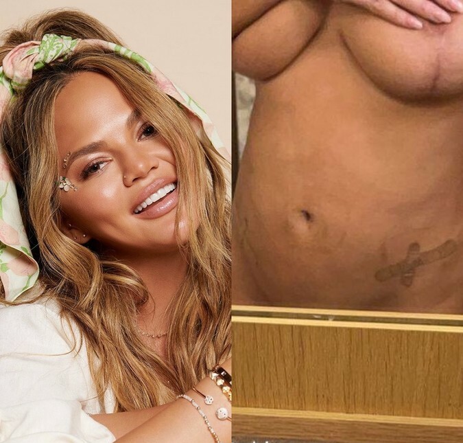 Chrissy Teigen mostra como ficou seu corpo após cirurgia e dispara: <i>Ame a si mesmo</i>