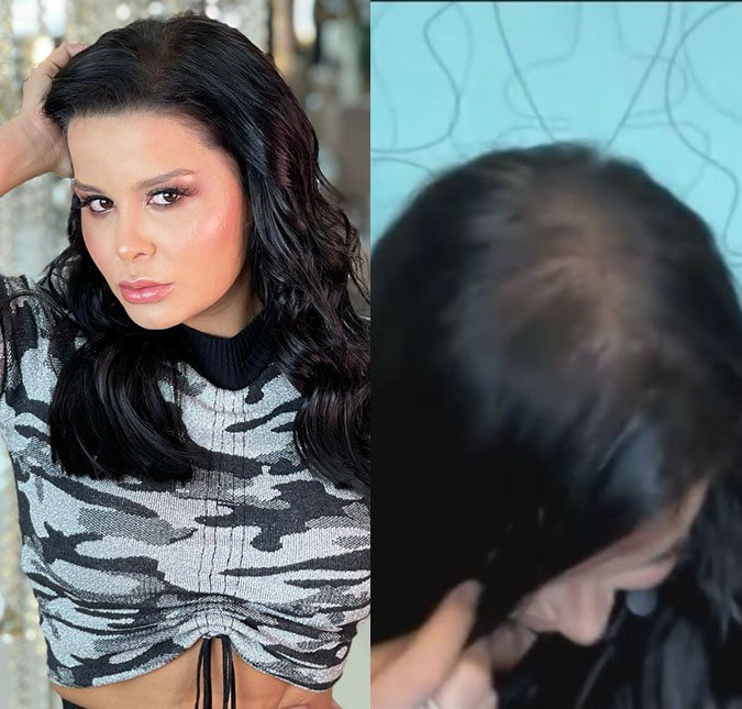 Maraisa fala sobre ter doença genética que causa calvície: <i>- Não tem que ter vergonha</i>