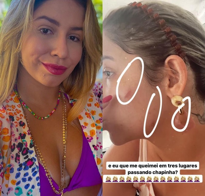 Marília Mendonça machuca o rosto com a chapinha: <i>Queimei em três lugares</i>