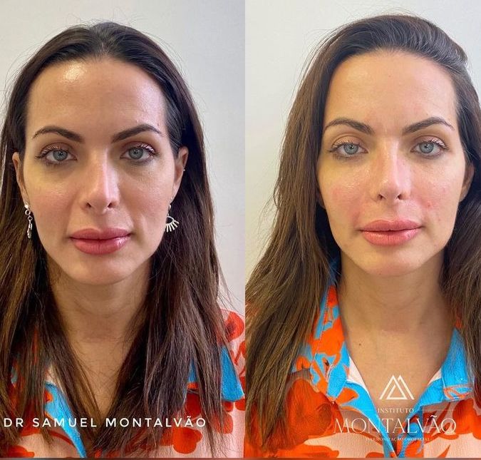 Carla Prata exibe antes e depois de procedimentos estéticos; compare!