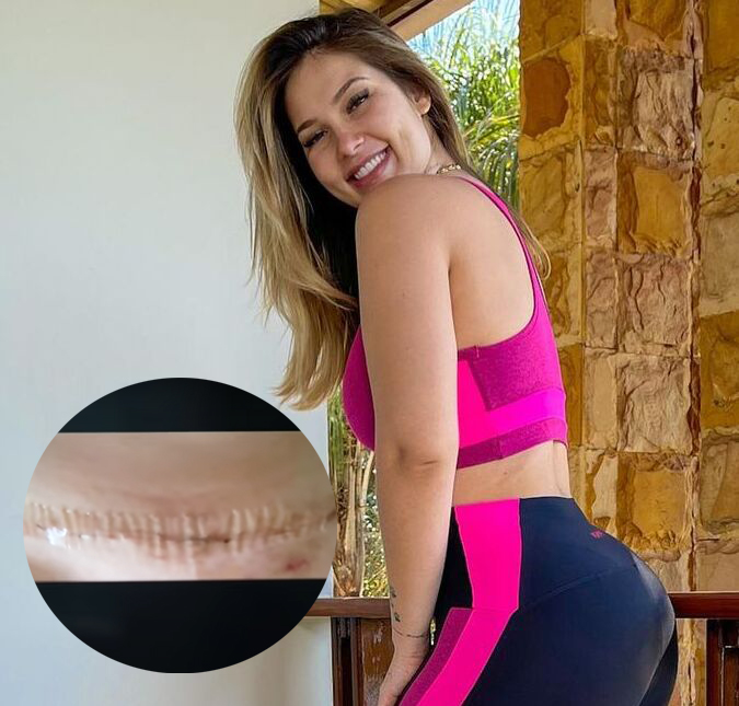 Após utilizar técnica diferente na cesárea, Virgínia Fonseca mostra como está a cicatriz; veja!