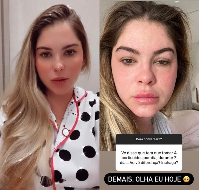 Bárbara Evans compartilha fotos de seu corpo inchado por conta de tratamento para engravidar