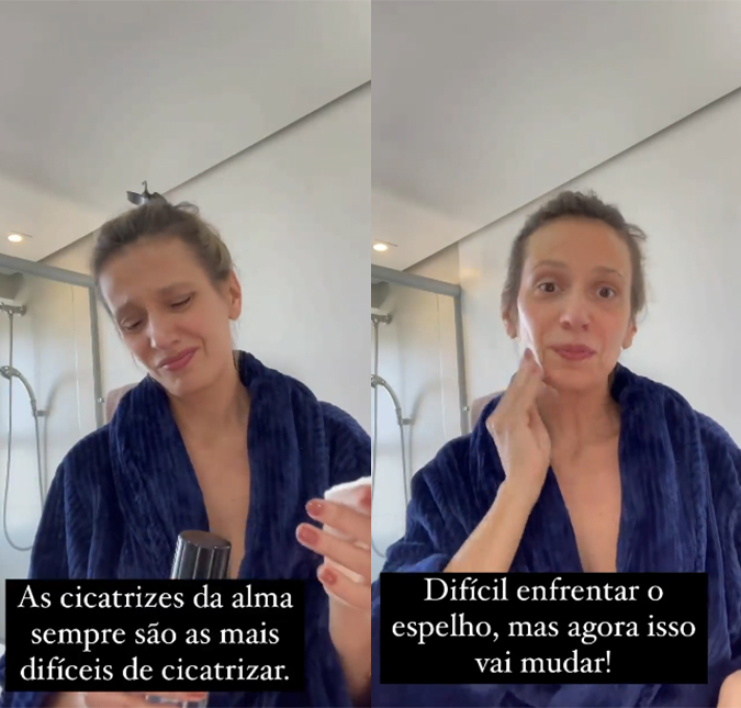 Após passar por lipo a mando do ex-marido, Luisa Mell desabafa nas redes sociais: <I>- Toda vez que eu me olho no espelho, eu ainda choro</I>