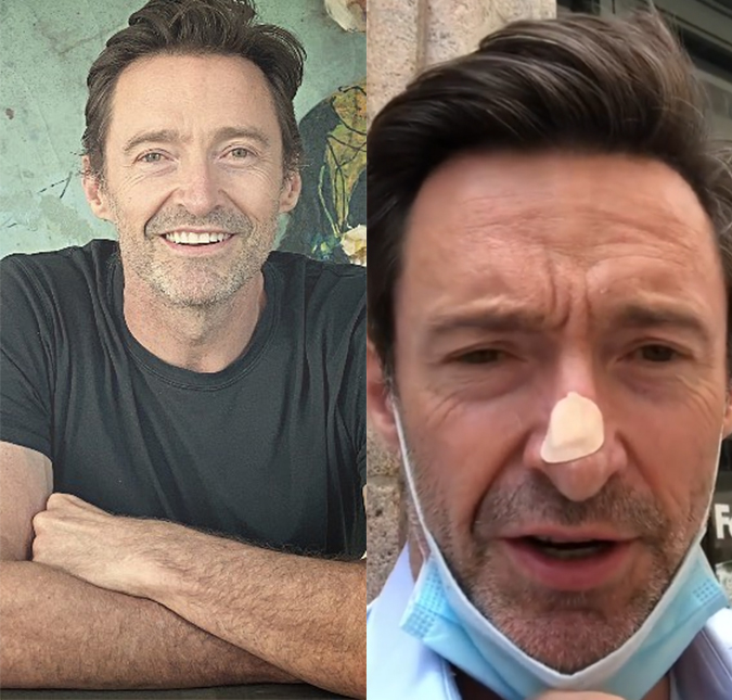 Hugh Jackman faz nova biópsia no nariz após já ter tratado de câncer de pele