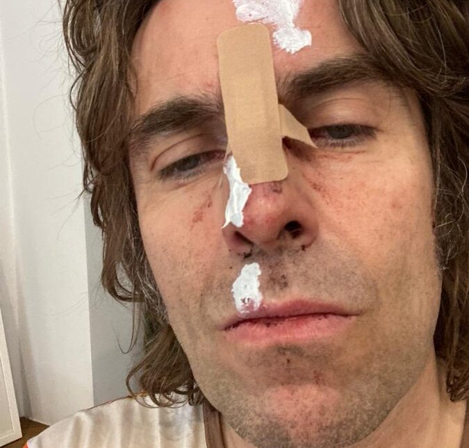 Liam Gallagher, da banda Oasis, aparece com rosto machucado após cair de helicóptero