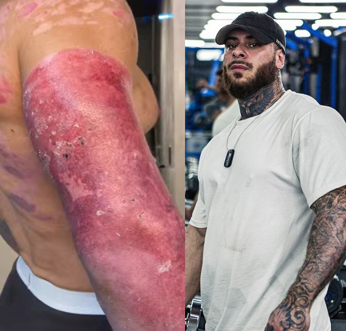 Léo Stronda mostra como ficou o corpo após a explosão de botijão de gás