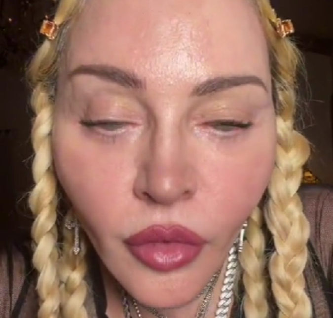 Madonna preocupa fãs com vídeo em que aparece com o rosto inchado; veja!
