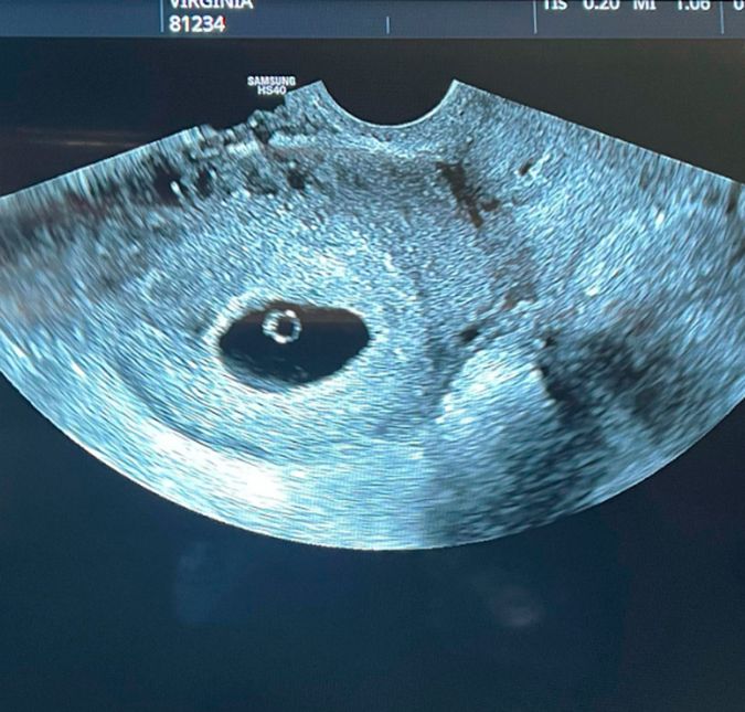 Quando realizou a primeira ultrassonografia, Virginia não deixou de compartilhar com seguidores e, toda orgulhosa, escreveu:  Primeira ultrassom do nosso bebê, que, por enquanto, é apenas um embriãozinho - e está tudo certo. Vocês acham que vem o José ou outra Maria?