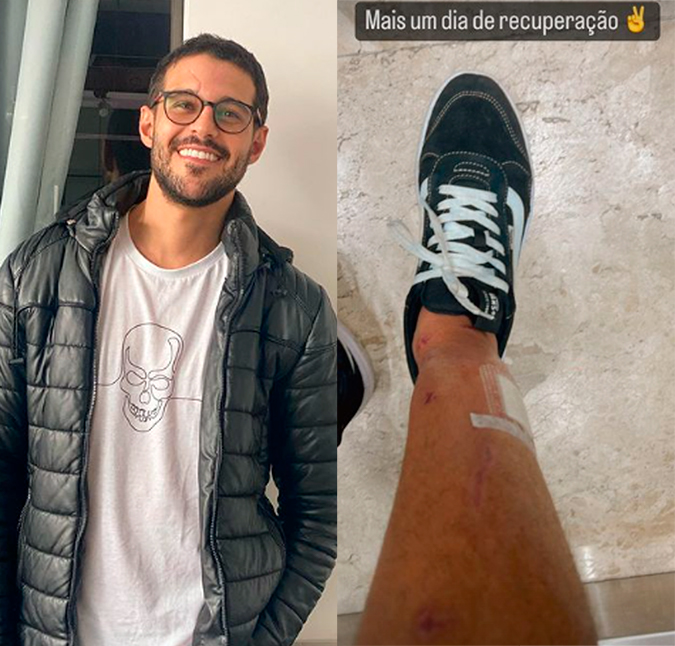 Rodrigo Mussi mostra como ficou a perna depois do acidente: <I>Mais um dia de recuperação</i>