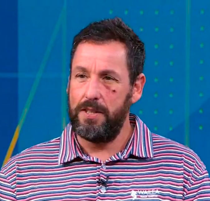 Adam Sandler surge com olho roxo em programa e revela motivo inusitado: - <i>Foi um acidente de cama</i>