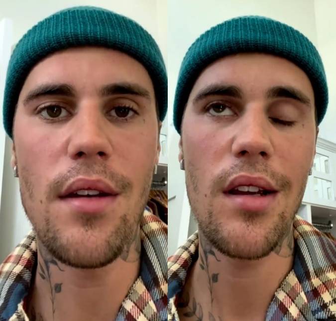 Justin Bieber revela que está com metade do rosto paralisado