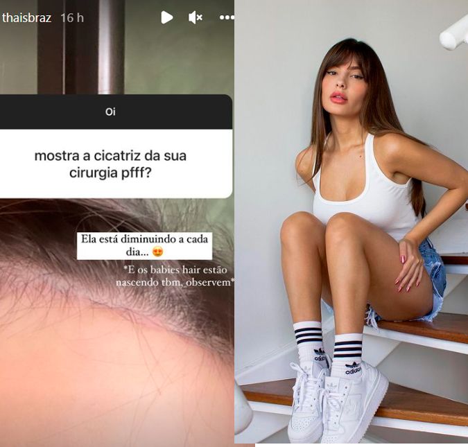Thaís Braz mostra pela primeira vez a cicatriz da cirurgia de redução de testa e comemora: Diminuindo a cada dia A ex BBB abriu uma caixinha de perguntas no Instagram para interagir com os fãs