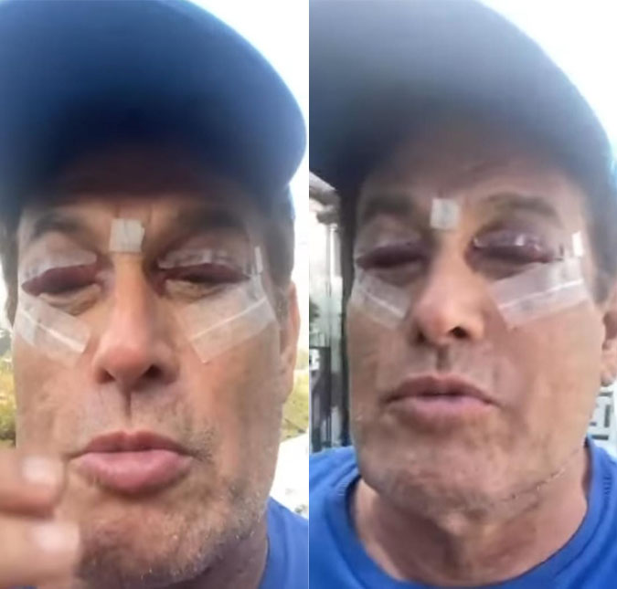 Sérgio Mallandro tranquiliza fãs após cirurgia nas pálpebras