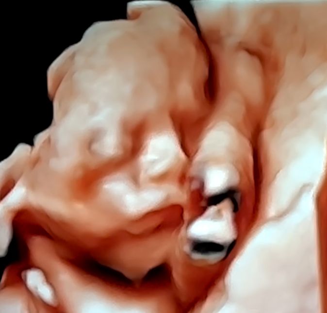 E claro que não ia ser diferente na última consulta de 2022, né? A youtube mostrou o ultrassom 3D e o rostinho de Lua. Empolgada, ela e Eliezer tentavam encontrar semelhanças entre eles e apontá-las na bebê. Meu Deus, é muito lindo, isso é muito legal, comentou Viih. E aí, com que será que a pequena irá se parecer quando nascer? E claro que não ia ser diferente na última consulta de 2022, né? A youtube mostrou o ultrassom 3D e o rostinho de Lua. Empolgada, ela e Eliezer tentavam encontrar semelhanças entre eles e apontá-las na bebê. Meu Deus, é muito lindo, isso é muito legal, comentou Viih. E aí, com que será que a pequena irá se parecer quando nascer?